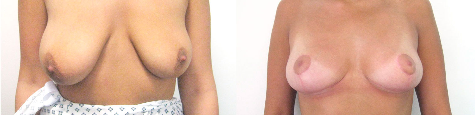 breast reduction before and after at 3 months